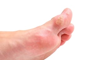 Warts on the palm