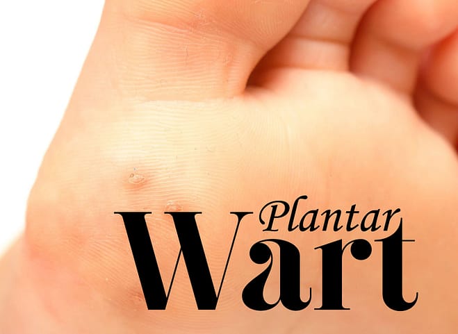 What Causes Foot Warts or Warts on the Palm